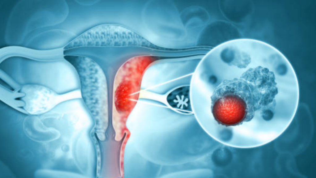 3 síntomas que toda mujer debe vigilar: podrían ser señales de cáncer de cuello uterino mortal